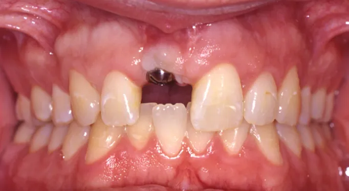 Die Einheilkappe des Implantats, sichtbar an der Stelle des fehlenden Zahns.