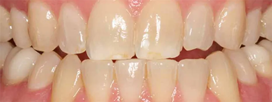 Dents avant le blanchiment