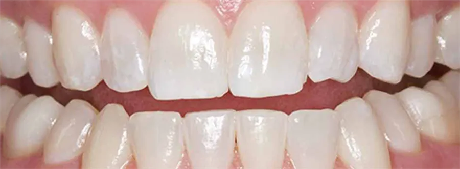 Dents après le blanchiment