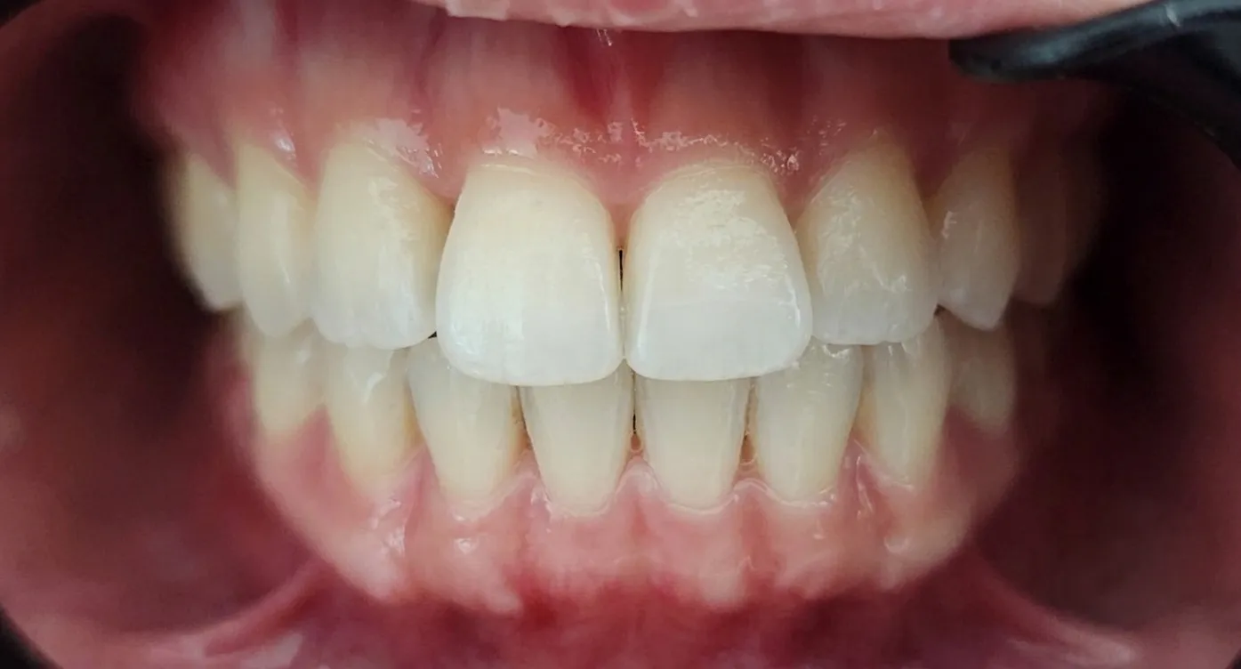 Après : les mêmes dents naturelles alignées et préservées.
