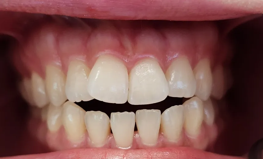 Avant : dents naturelles présentant une béance.