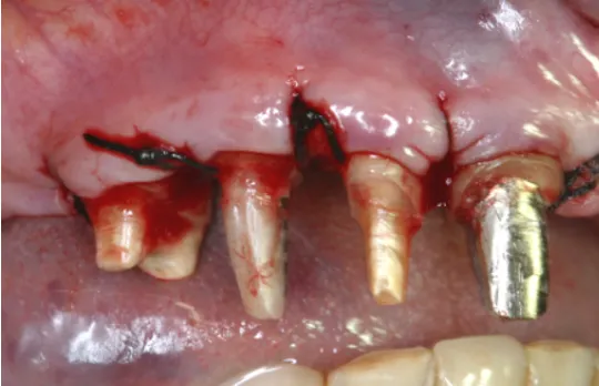 Dents reconstruites par tenons et moignons