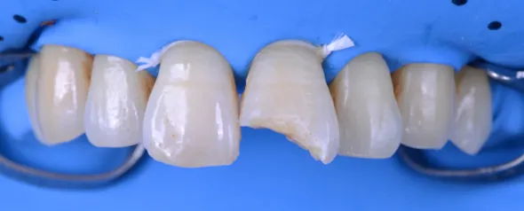 Restauration en composite avant