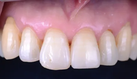 Restauration en composite après