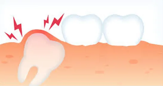 Dent de sagesse à l’origine de douleurs et d’infections