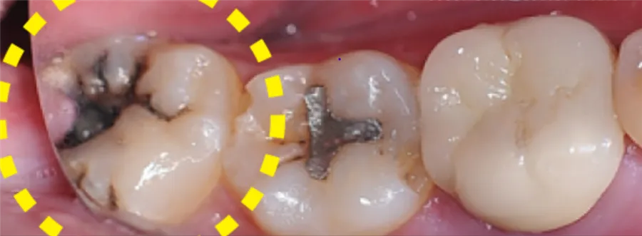 Dents de sagesse difficiles à nettoyer