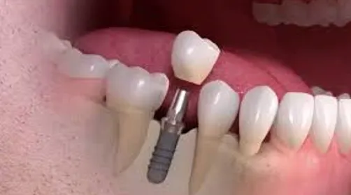 Illustration d’un implant dentaire remplaçant une dent