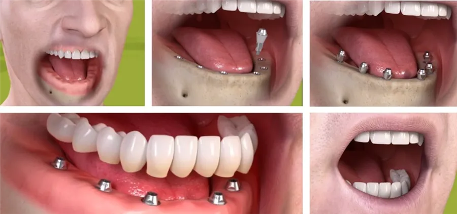 Prothèse totale fixée sur implants