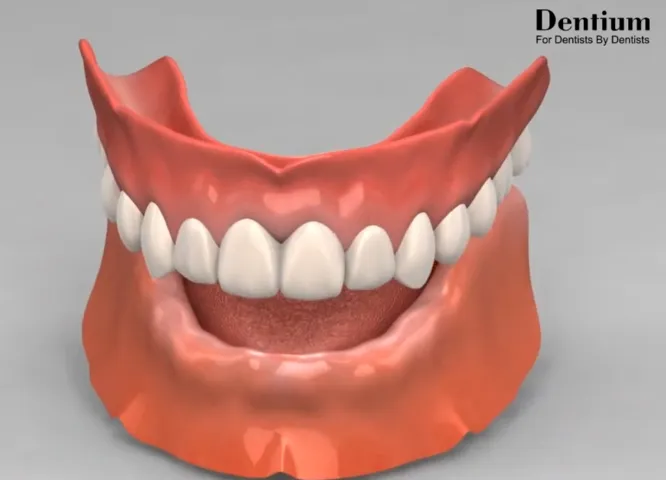 Overdenture supportée par des implants