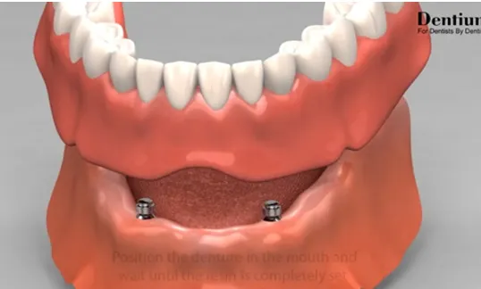 Deux implants dans la mâchoire inférieure