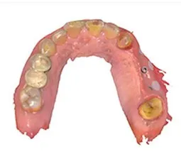 Illustration de l’overdenture sur implants