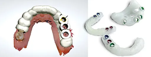 Guide chirurgical imprimé en 3D