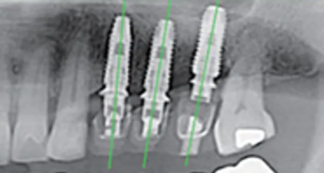 Pose des implants à l’aide du guide chirurgical