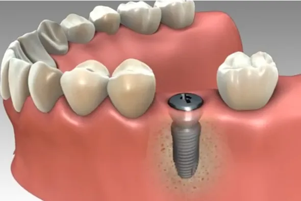 Insertion chirurgicale de l’implant