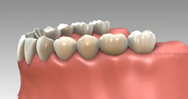 Couronne définitive fixée sur l’implant