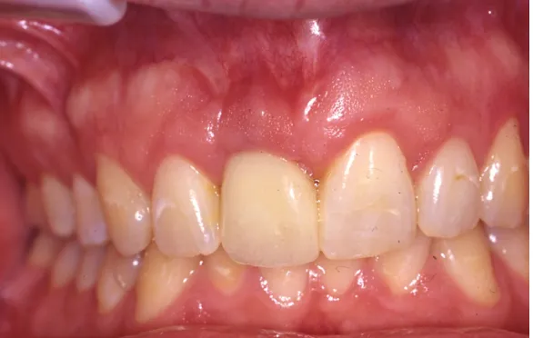 Mise en forme de la gencive autour de l’implant