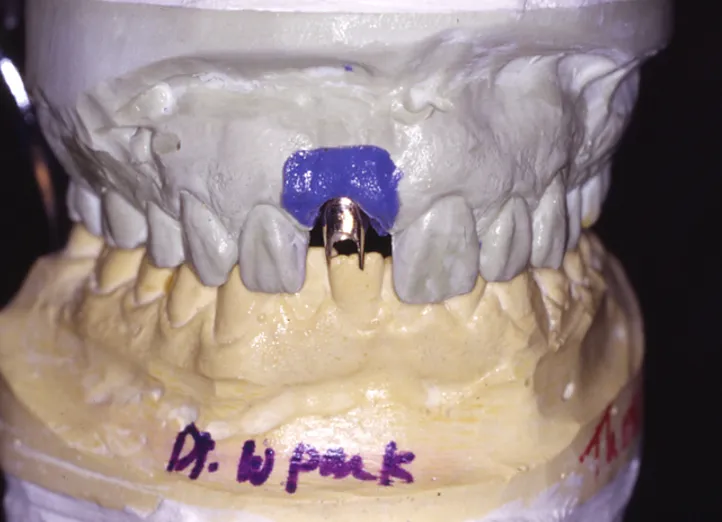 Pilier sur mesure de l’implant