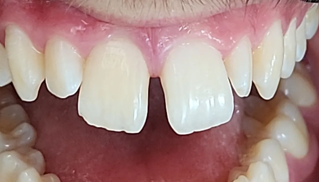 Schliessen eines Diastemas mit Invisalign · Vorher