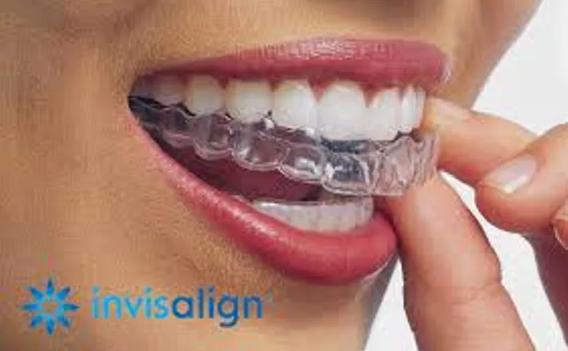 Système Invisalign