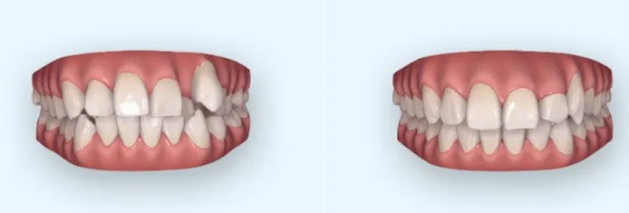 Simulation 3D du traitement