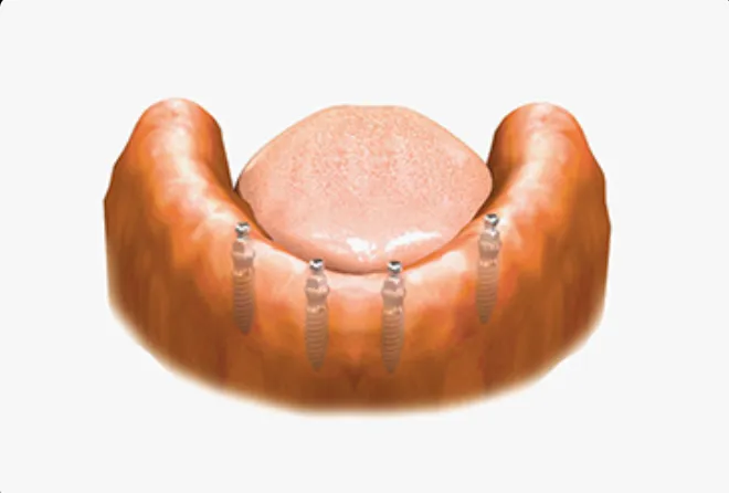 Pose des implants dentaires en titane