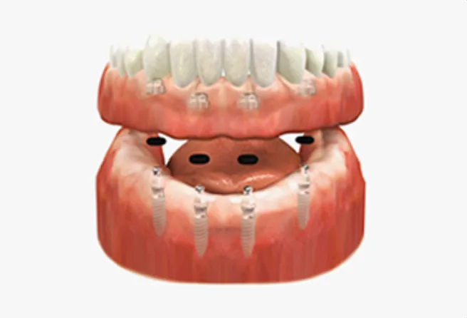 Fabrication de l’overdenture sur mesure