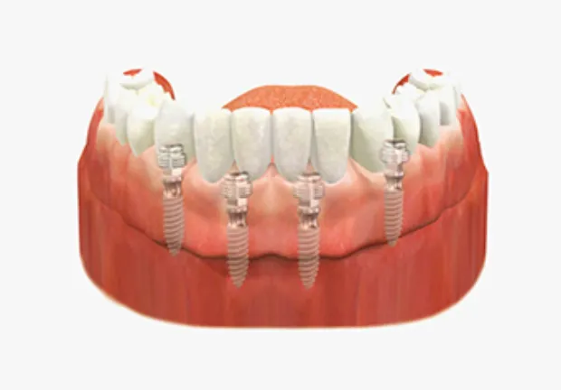 Installation de l’overdenture sur implants
