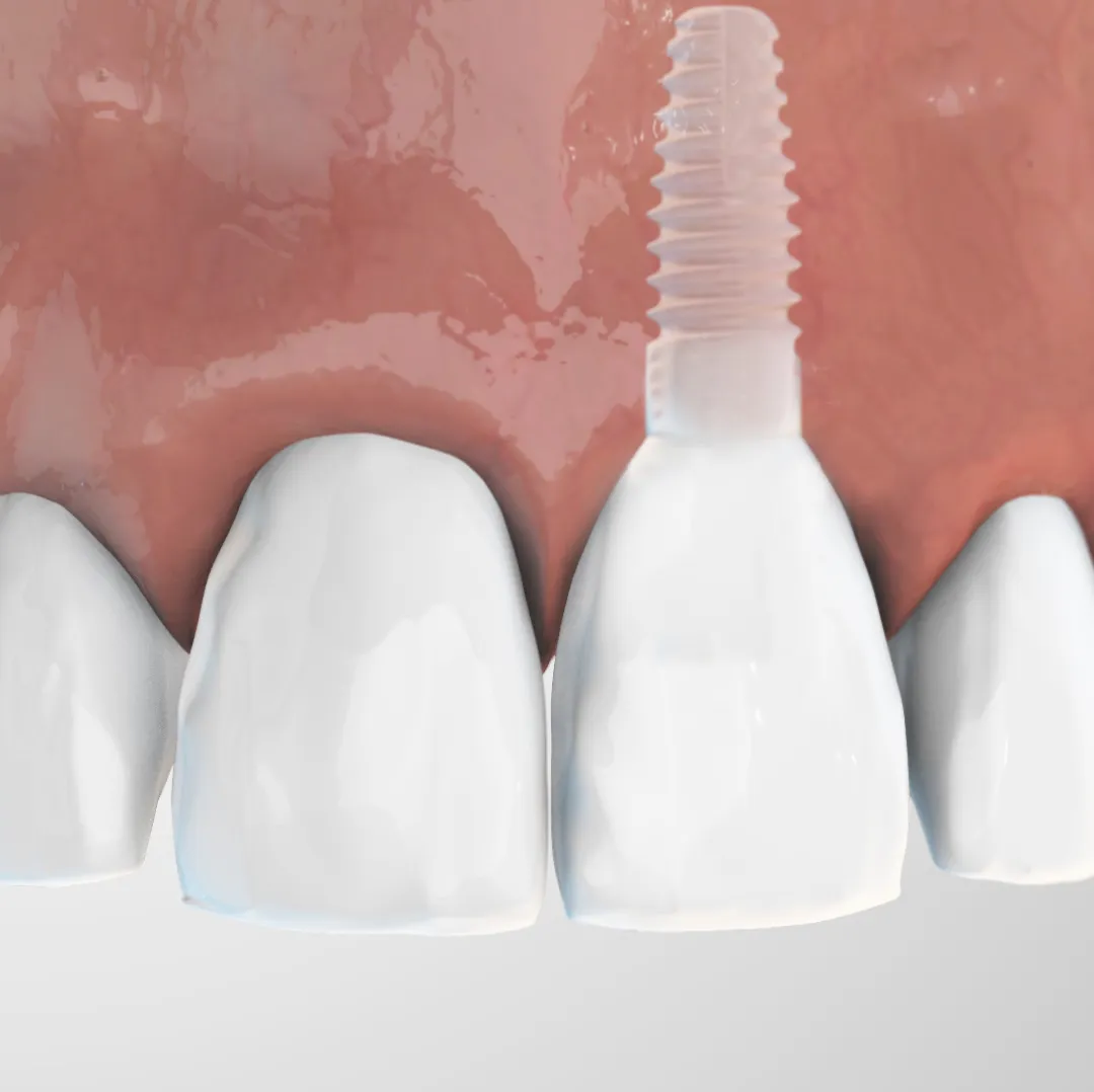 Implant céramique ZERAMEX posé dans la gencive, avec sa couronne, entre des dents naturelles.
